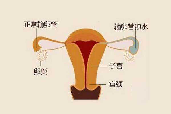 广州国内代孕需要多少钱-代孕妈妈服务_输卵管性不孕是否会影响试管婴儿助孕